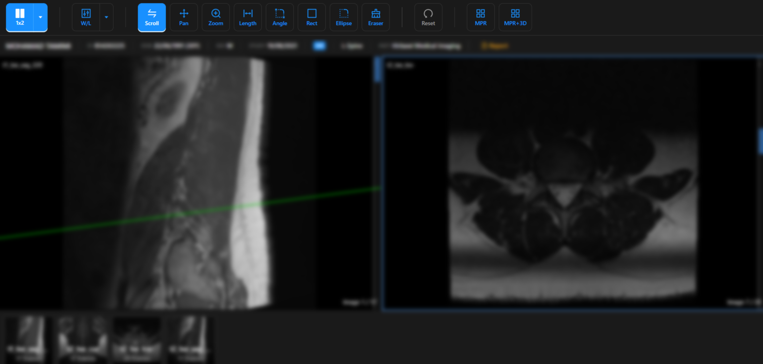 Envision RIS web DICOM viewer showing MPR views of a spine MRI