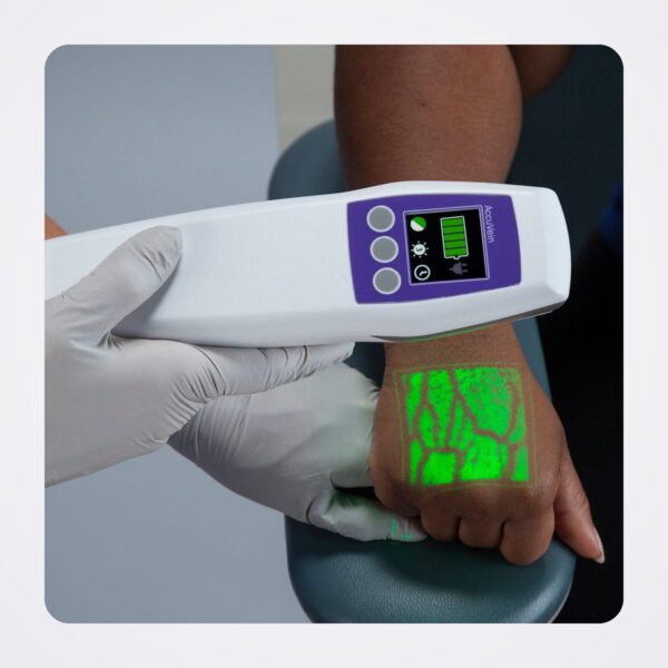 AccuVein AV500 projecting a green vein map onto the back of a patient's hand