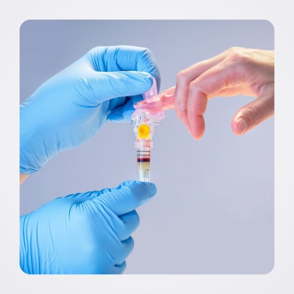 Gloved hands holding a BD MiniDraw finger sleeve on a patient's fingertip with the capillary tube attached