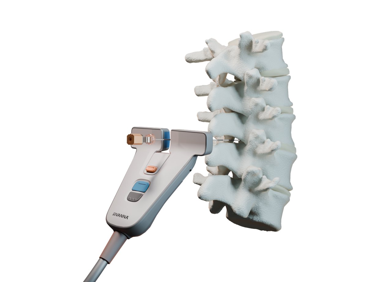 RIVANNA Accuro 3S AI Ultrasound Guidance for Neuraxial Anaesthesia 3 Accuro 3S Dual Array ultrasound probe beside a lumbar spine model